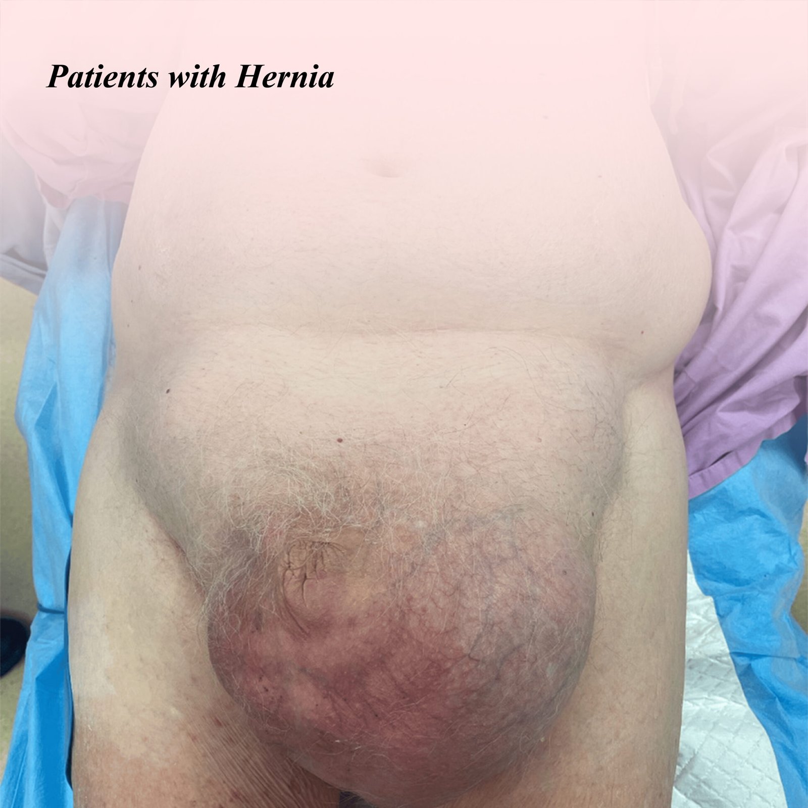 Hernia Management